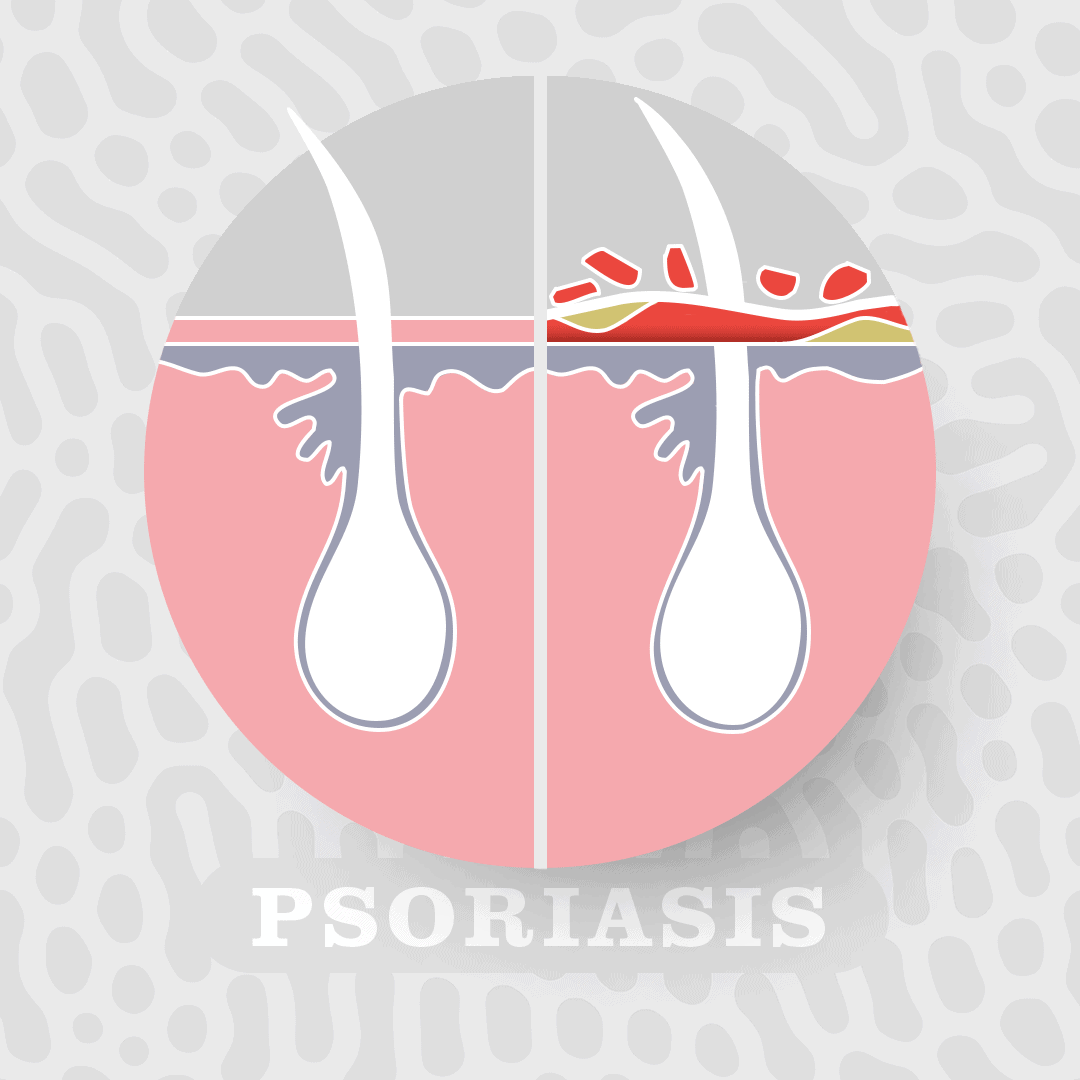  psoriasis skin