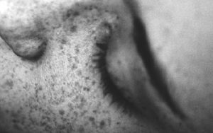Woman's freckles staphylococci