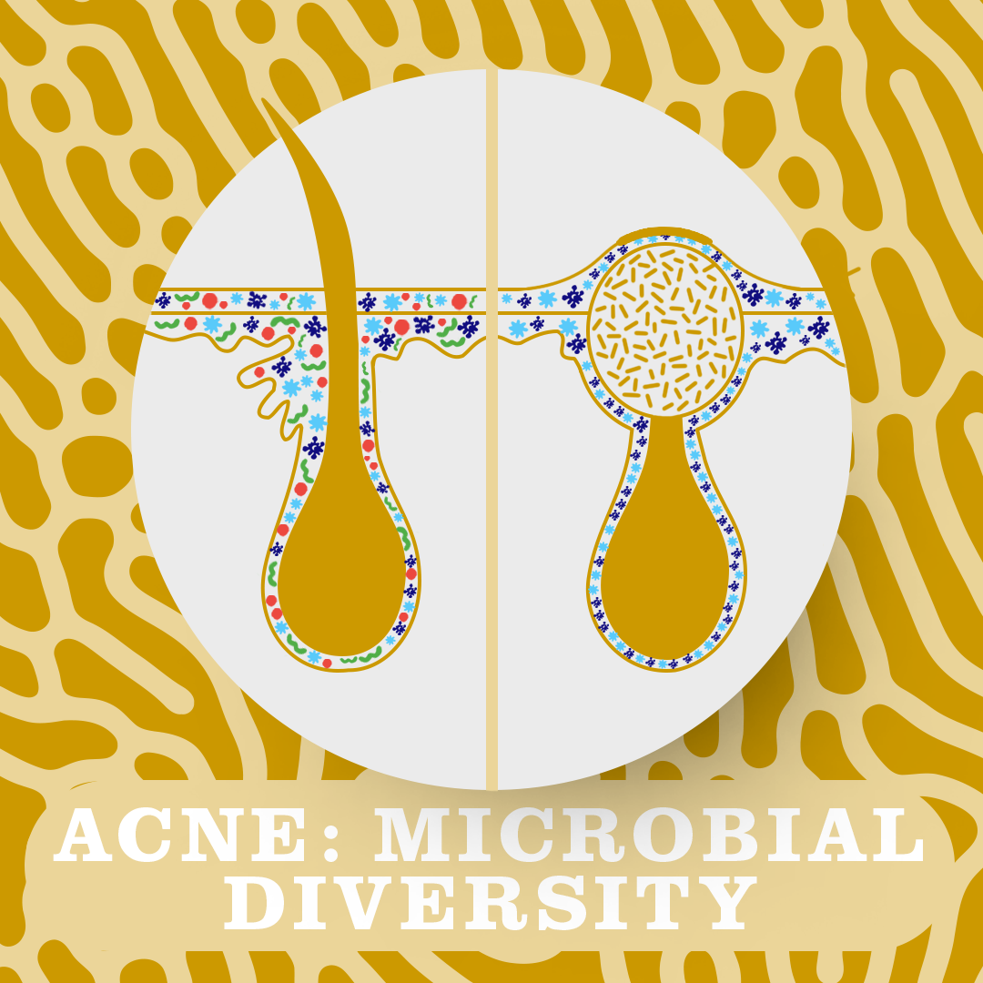 Microbial diversity in acne