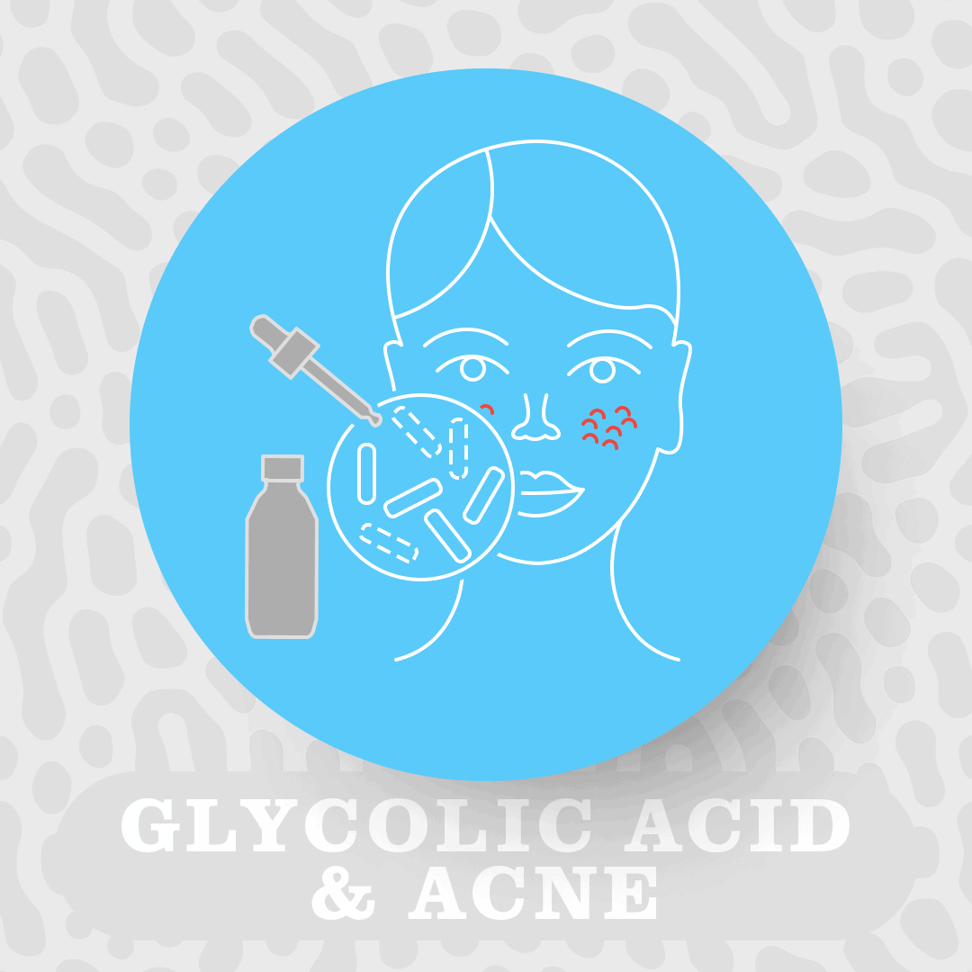 Glycolic acid & acne